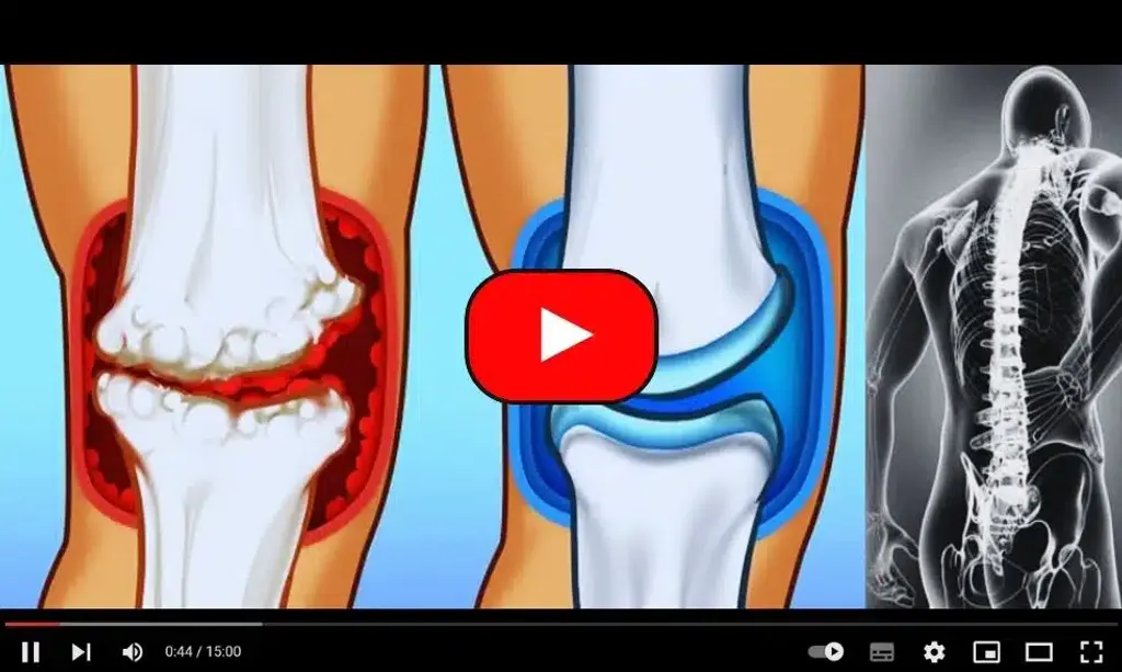 Arthritis Or Joint Pain? Watch This