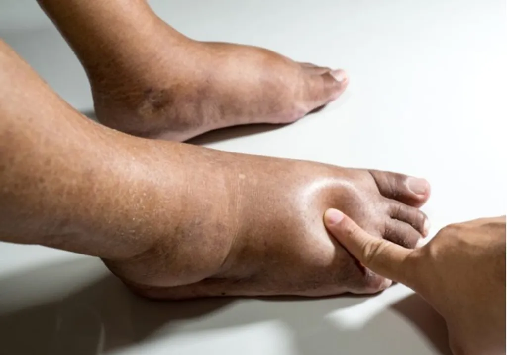 Swollen Feet & Ankles? Try The 'Fluid Retention' 2-Minute Ritual At Home